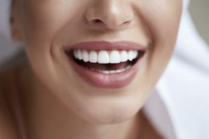 veneers