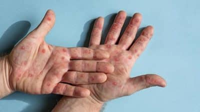 hands showing mpox rash infection
