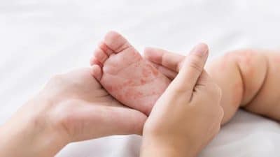 child infant measles rash